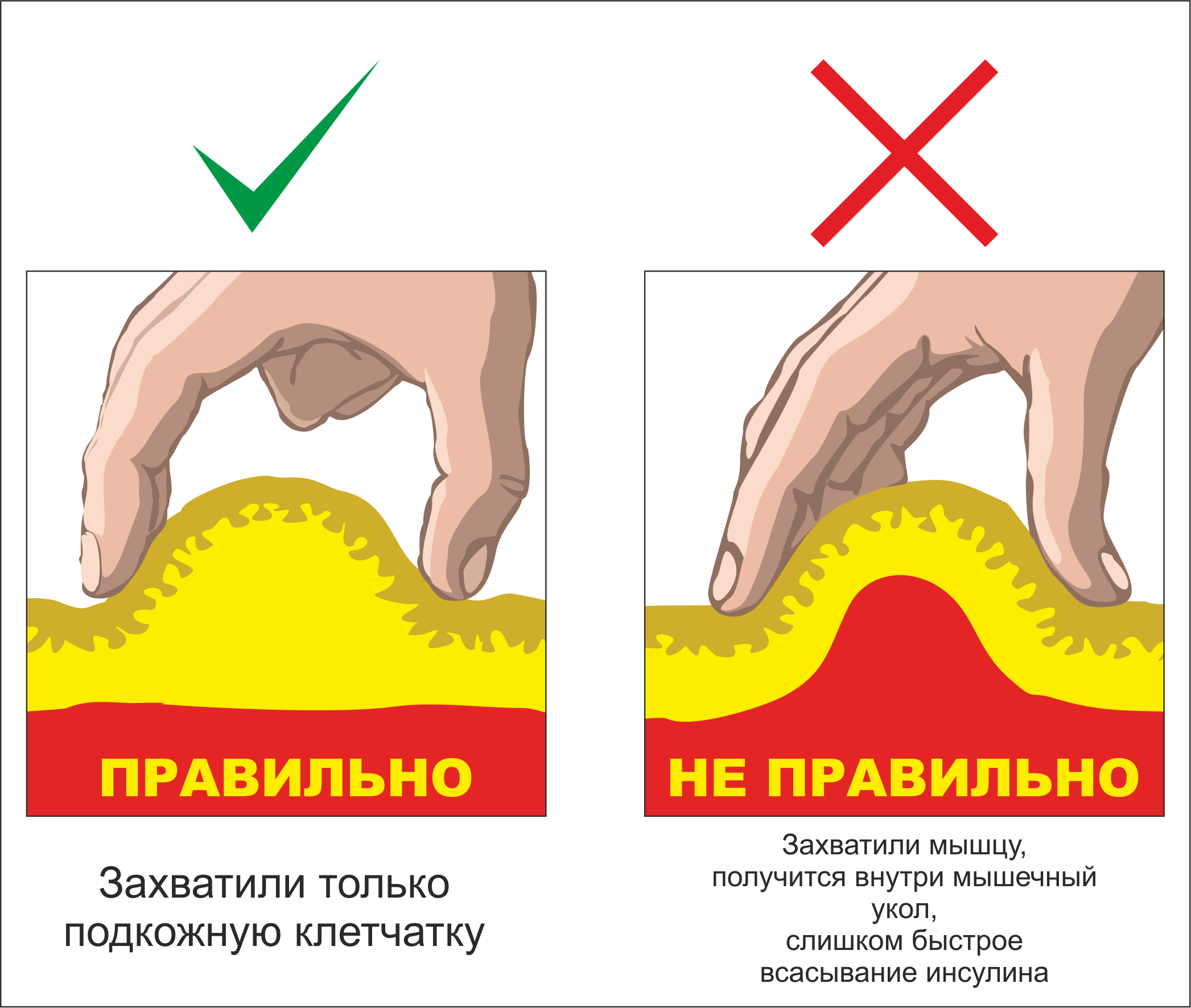 Что такое инфильтрат